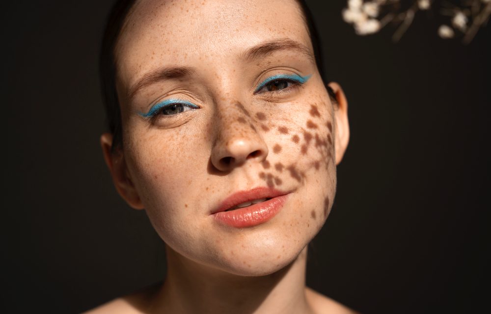 Macchie cutanee Cuneo: come trattarle da un professionista