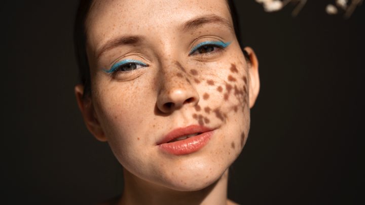 Macchie cutanee Cuneo: come trattarle da un professionista